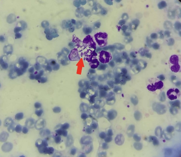 Peripheral blood film with many pale, irregular red cells and bacillary forms, arrowed, in a cluster of neutrophils