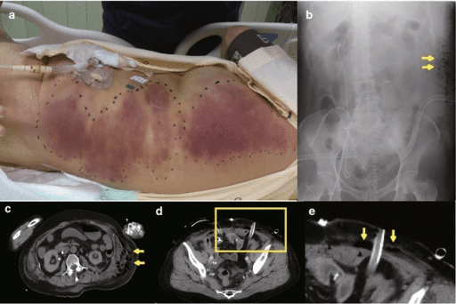 Postoperative gas gangrene - clinical and imaging correlation