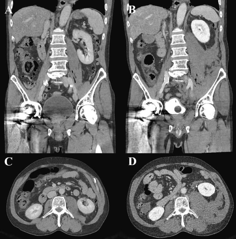 Coronal (A, B) and axial (C, D) CT: a few gas locules beside the patient's left psoas in A, and massive swelling of the left iliopsoas with streaks of gas in B and D