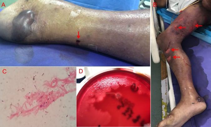 Four panels: a small lower-leg wound beside a large dark bulla; the whole leg swollen and dusky with bullae; a stained smear with bacilli; colonies on a red agar plate