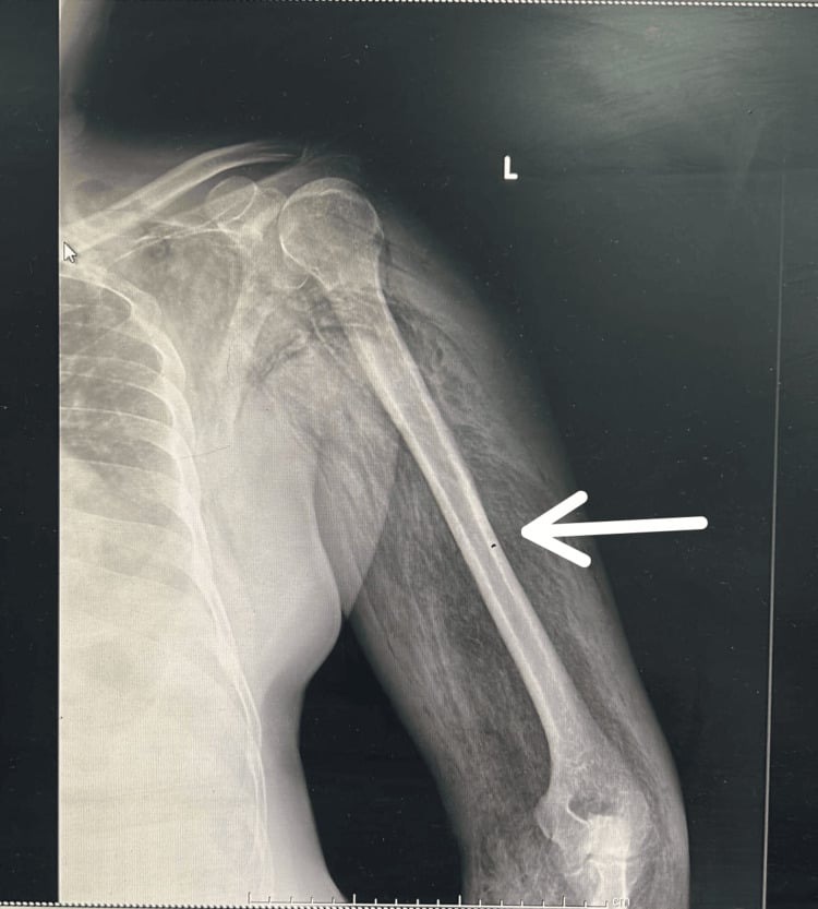 Radiograph of the left shoulder and arm with streaky gas lucencies along the soft tissues of the arm; an arrow marks the mid-arm