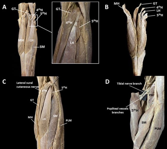Cadaveric posterior-leg panels showing a five-headed gastrocnemius variant, its separate proximal attachments, lateral sural cutaneous nerve and neurovascular bundle.