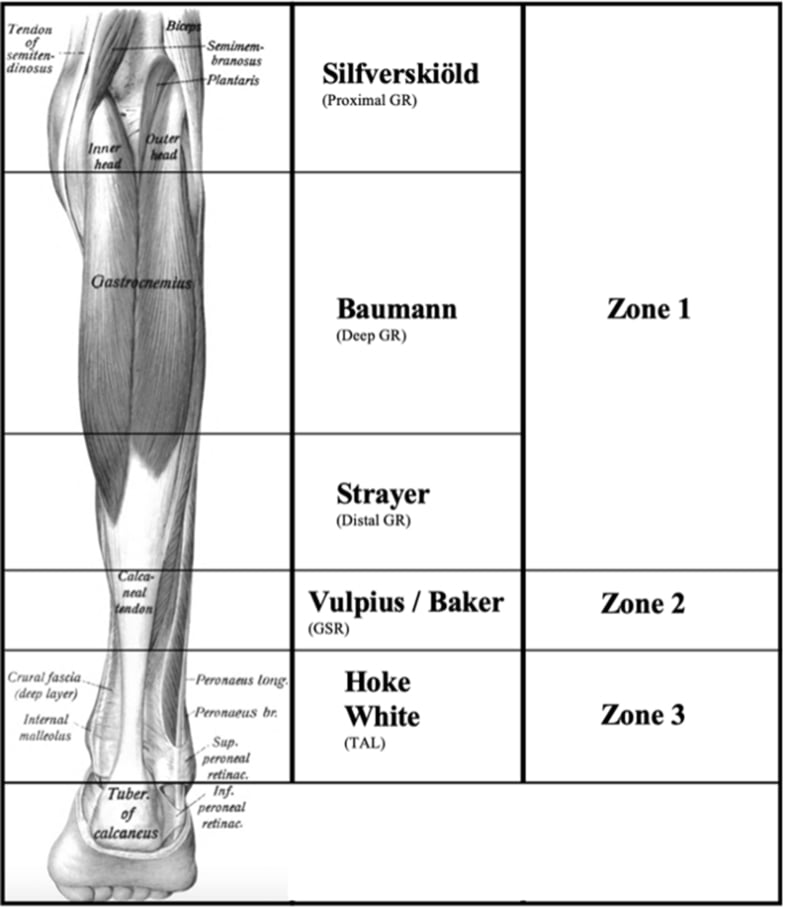 Anatomical chart locating SilfverskiΓΆld, Baumann, Strayer, Vulpius-Baker and Achilles-level lengthening within three triceps-surae zones.