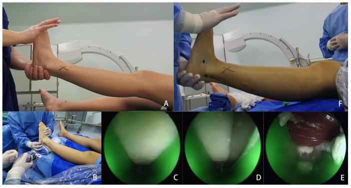 Operative sequence for endoscopic gastrocnemius recession showing positioning, endoscopic identification and division of the gastrocnemius aponeurosis.