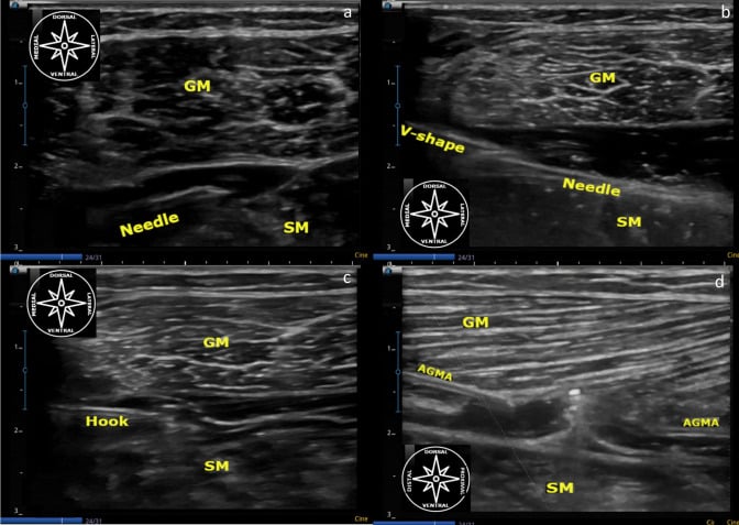 Ultrasound-guided gastrocnemius intramuscular aponeurosis recession showing hydrodissection, hook passage and monitored aponeurotic division.
