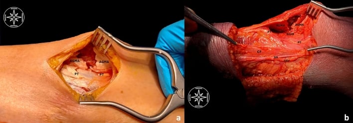 Cadaveric proof after gastrocnemius intramuscular aponeurosis recession showing the divided aponeurosis and plantaris with the sural nerve and great saphenous vein preserved.