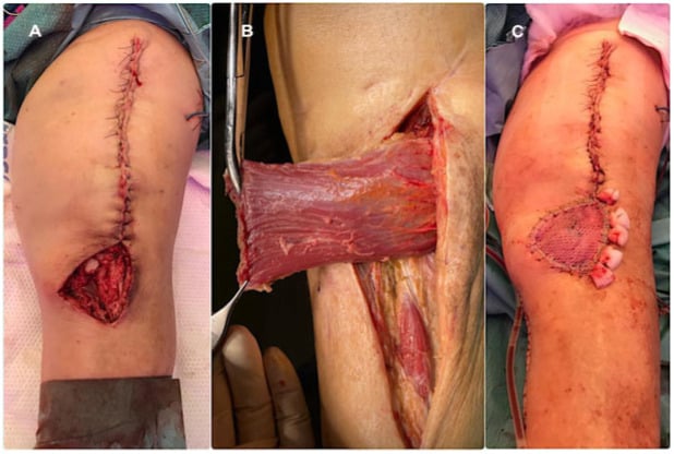 Clinical sequence showing an infrapatellar knee defect, elevation of a medial gastrocnemius flap and final split-thickness skin-graft coverage.