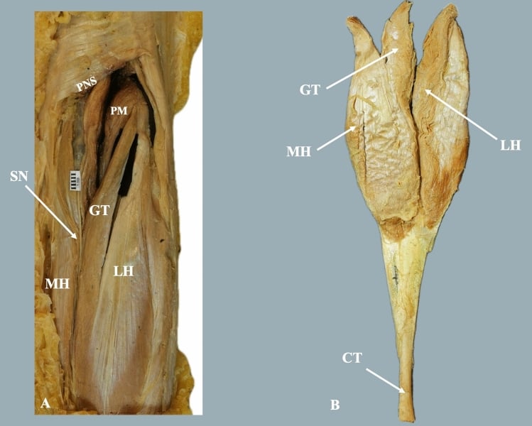 Cadaveric dissections showing gastrocnemius tertius arising beside the medial or lateral head, with the sural nerve and popliteal neurovascular structures identified.