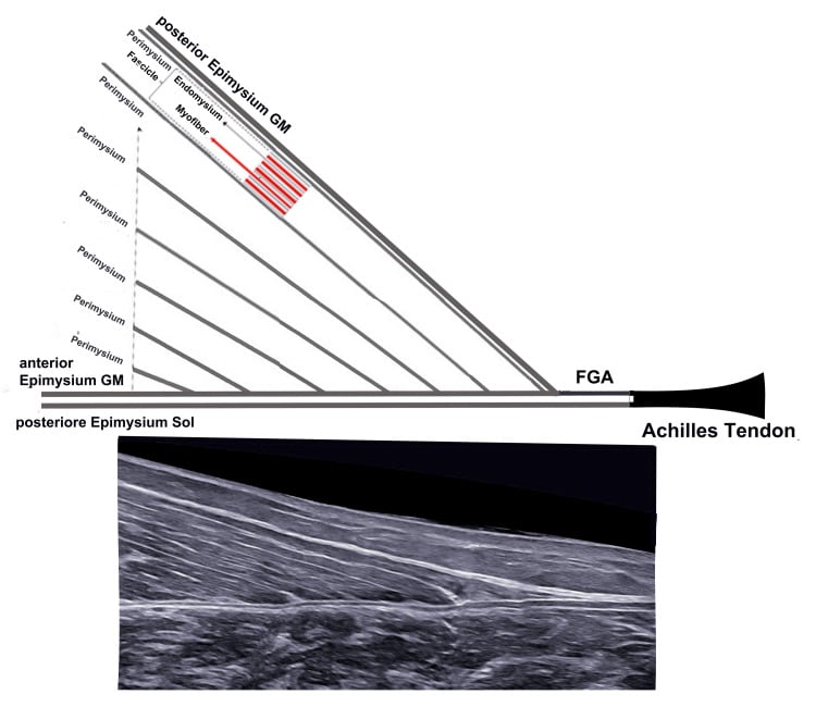 Diagram and axial ultrasound showing continuity from medial gastrocnemius connective tissue into the free gastrocnemius aponeurosis and Achilles tendon.