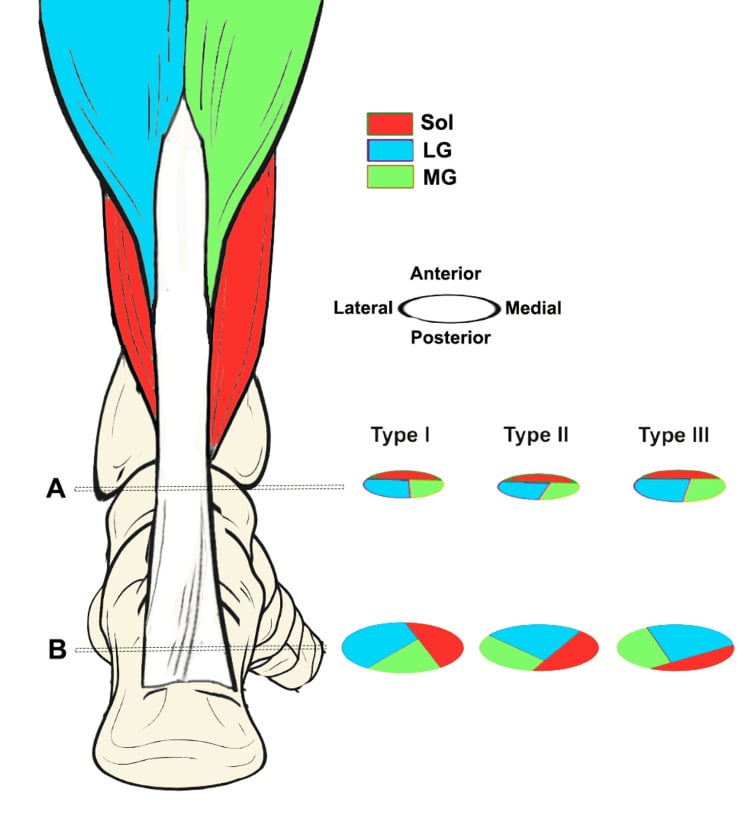 Posterior schematic and cross-sections showing the spiral arrangement of soleus, lateral gastrocnemius and medial gastrocnemius subtendons within the Achilles tendon.