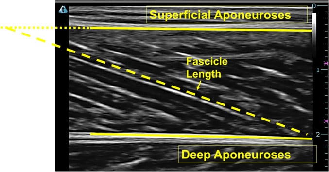 Long-axis ultrasound of medial gastrocnemius with superficial and deep aponeuroses and fascicle length identified.