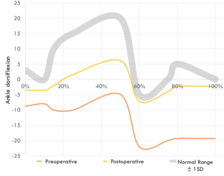 Gait-cycle graph comparing ankle dorsiflexion before and after Vulpius gastrocnemius recession with the reference range.