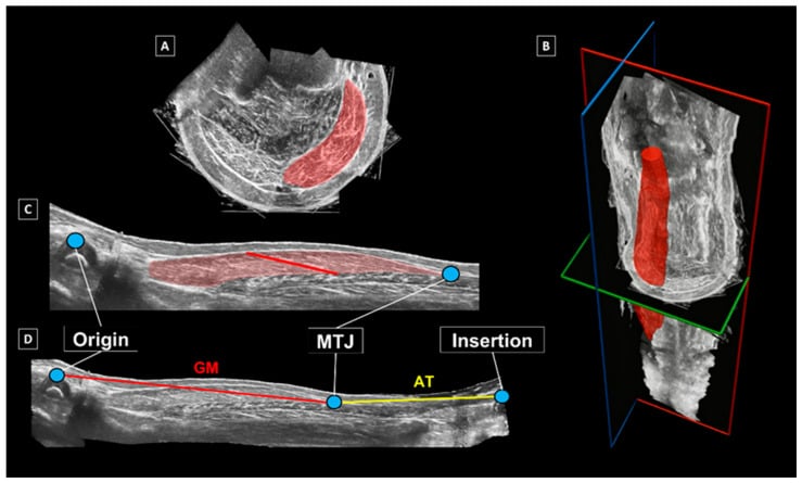 Multiplanar ultrasound and three-dimensional segmentation of medial gastrocnemius showing origin, musculotendinous junction, insertion and fascicle measurement.