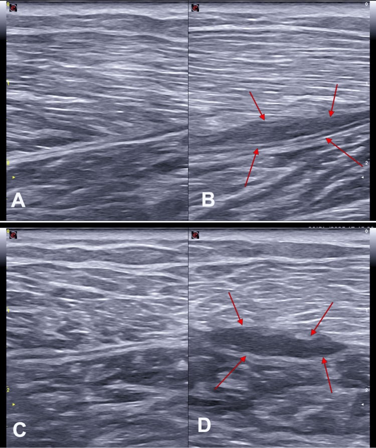 Long- and short-axis ultrasound comparing healthy and injured medial gastrocnemius, with arrows marking fascial detachment and fluid at the injury plane.