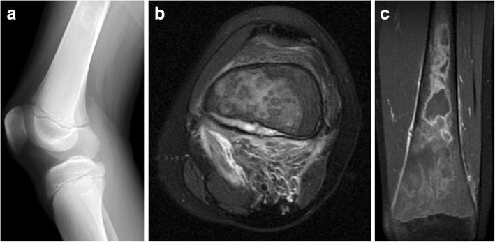 Lateral knee radiograph and MRI showing Gaucher bone infarction with subperiosteal haemorrhage mimicking osteomyelitis