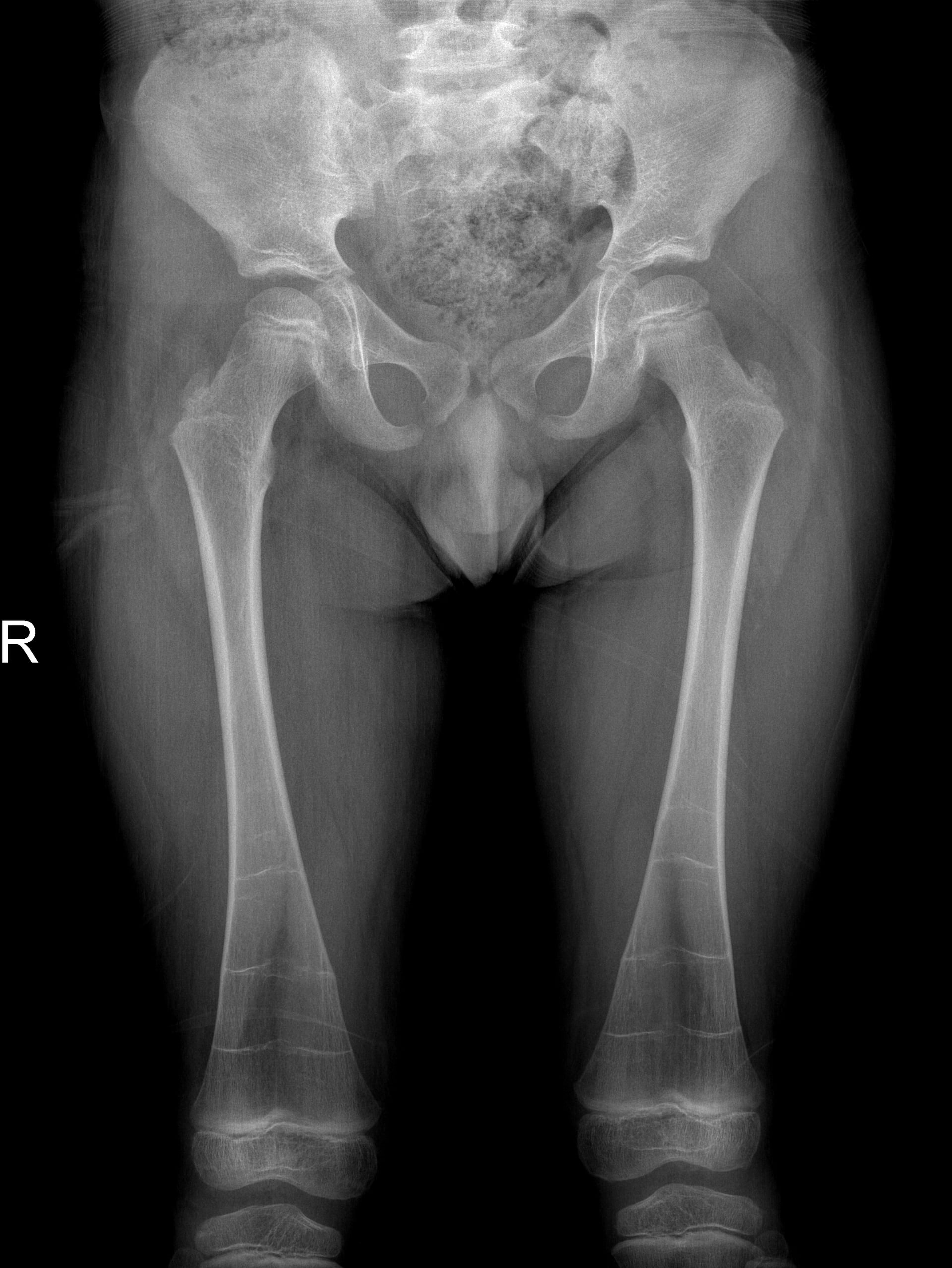 Frontal radiograph of both femora showing widened, under-modelled distal femoral metaphyses - the Erlenmeyer flask deformity.
