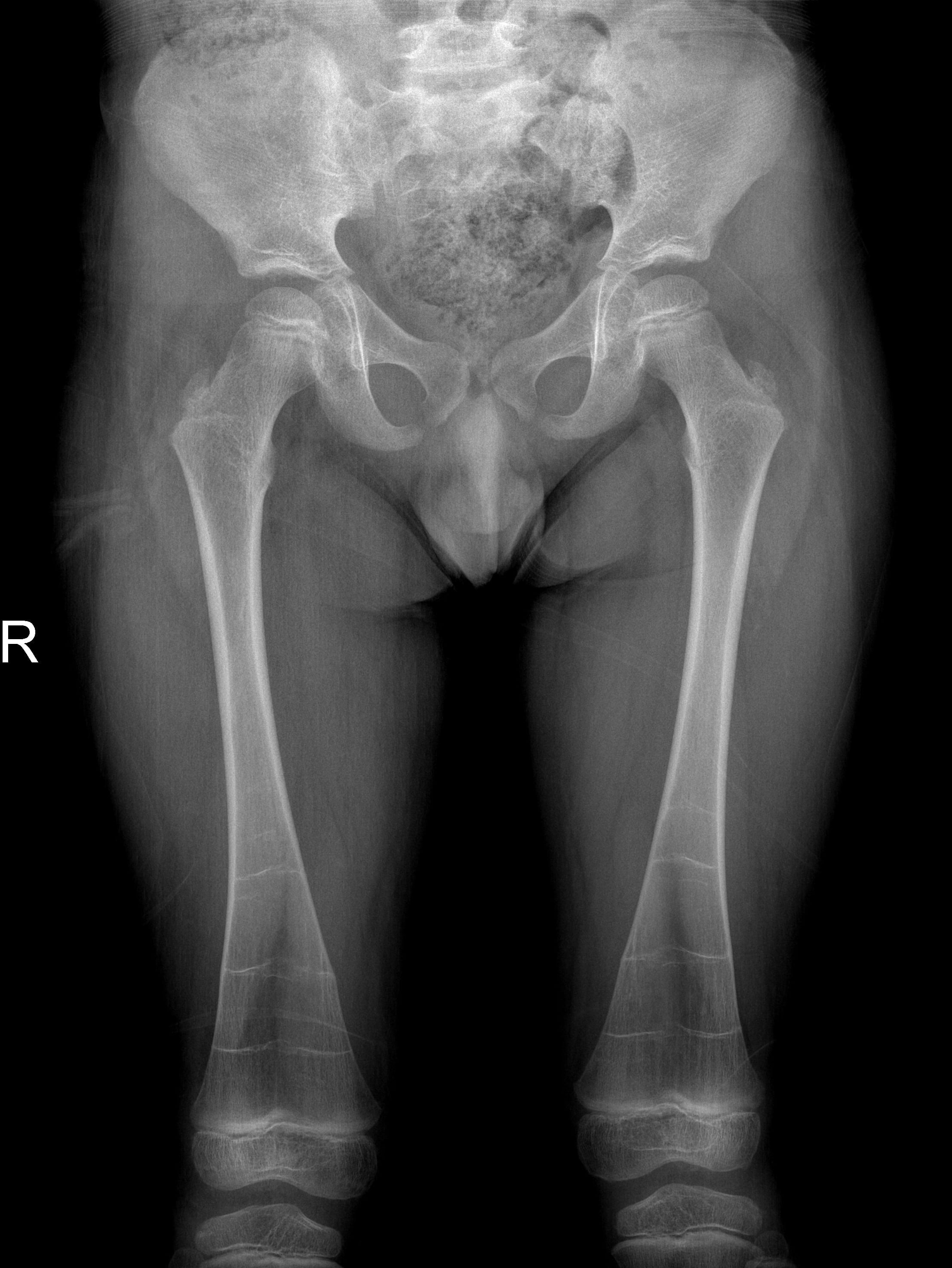 Frontal radiograph of both femora showing widened, under-modelled distal femoral metaphyses - the Erlenmeyer flask deformity.