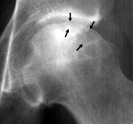 Close-up hip radiograph showing a subchondral crescent lucency in the femoral head (arrows), the crescent sign of avascular necrosis.