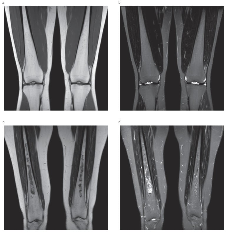 Coronal T1 and STIR MRI of both femora showing heterogeneous Gaucher marrow infiltration without osteonecrosis
