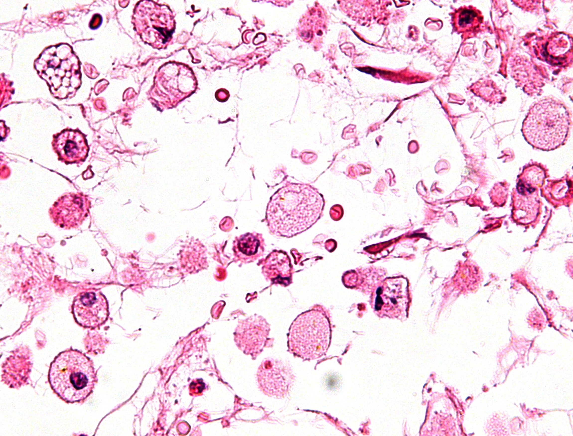 High-magnification H&E micrograph of bone marrow showing several large Gaucher cells - macrophages with abundant pale, finely-striated cytoplasm and small eccentric nuclei.