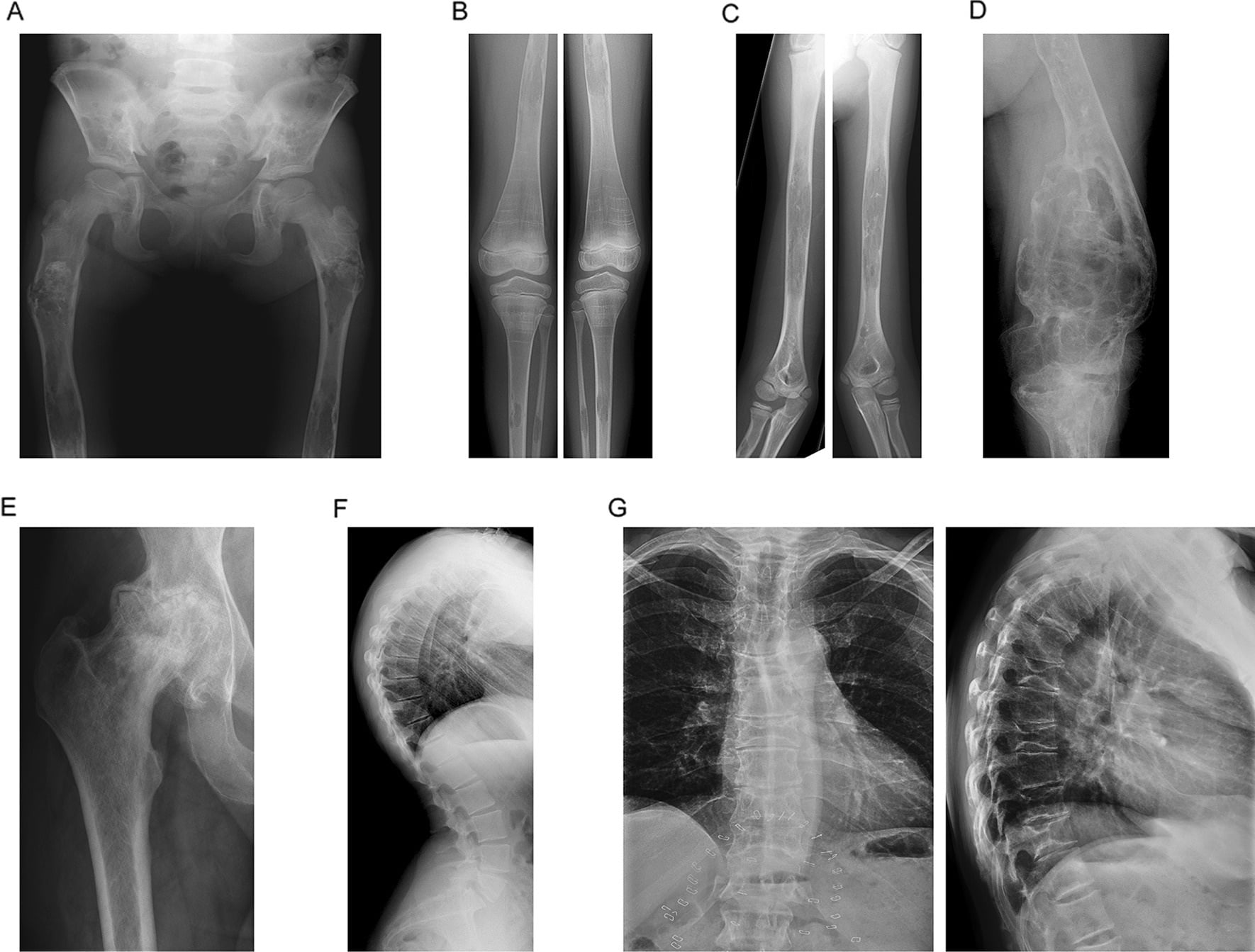 Composite radiographs showing osteopenia, lytic change, pathological fractures, Erlenmeyer flask deformity, coarse trabeculation and vertebral compression in Gaucher disease