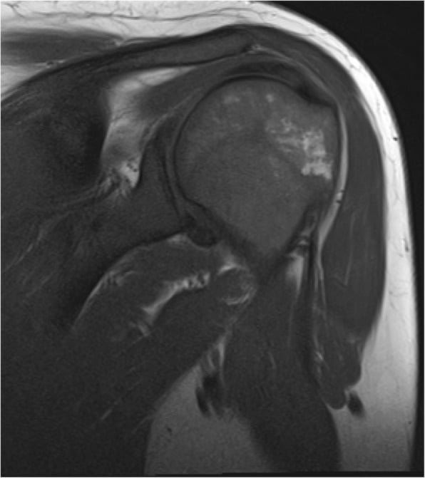 Coronal T1-weighted shoulder MRI showing diffuse low-signal Gaucher marrow infiltration of the humerus
