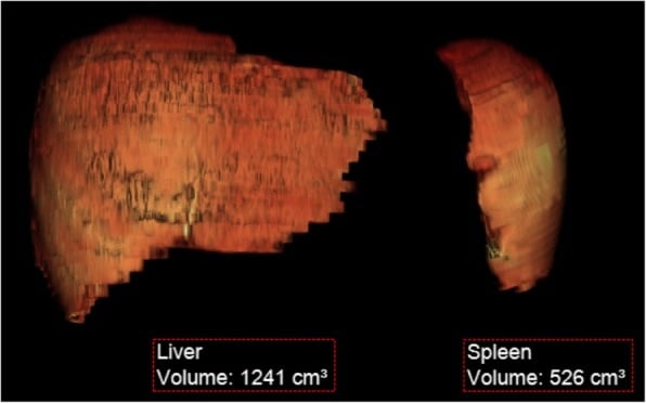 Three-dimensional MRI reconstructions of enlarged liver and spleen used for Gaucher organ-volume monitoring