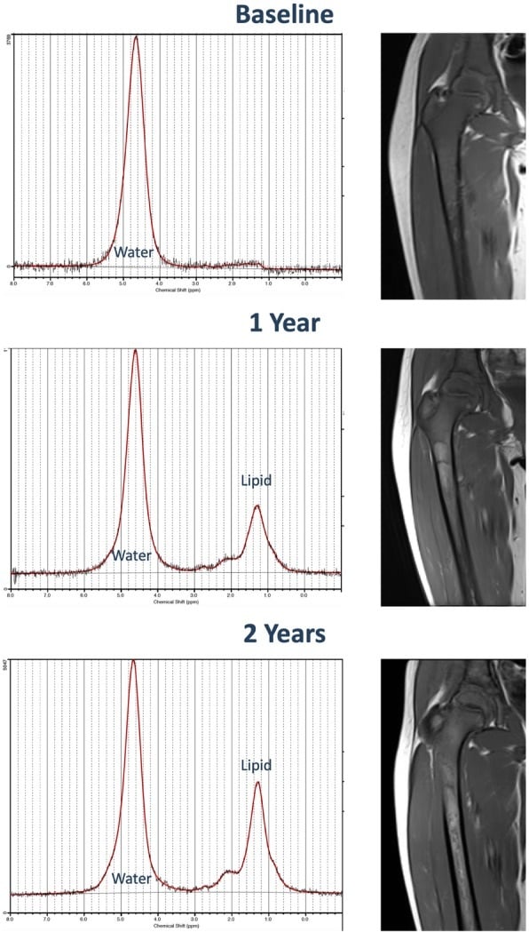 Serial femoral T1 MRI and magnetic resonance spectra showing increasing marrow fat fraction during enzyme replacement therapy