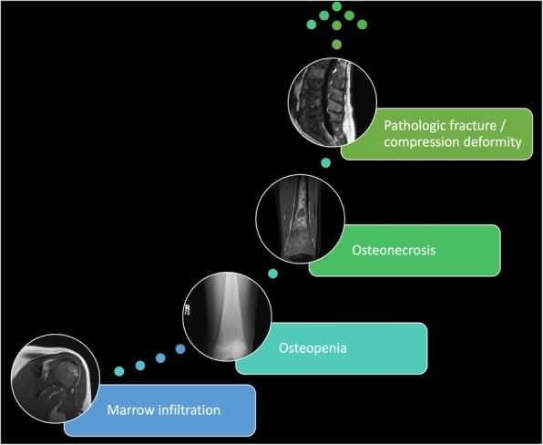 Diagram of the skeletal spectrum in Gaucher disease from marrow infiltration through osteopenia and osteonecrosis to pathological fracture