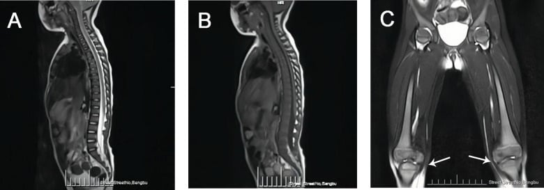 Sagittal T2 and T1 spine MRI with coronal femoral MRI showing diffuse marrow infiltration and distal femoral metaphyseal widening