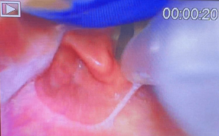 Glottic view on the screen of a videolaryngoscope during tracheal intubation