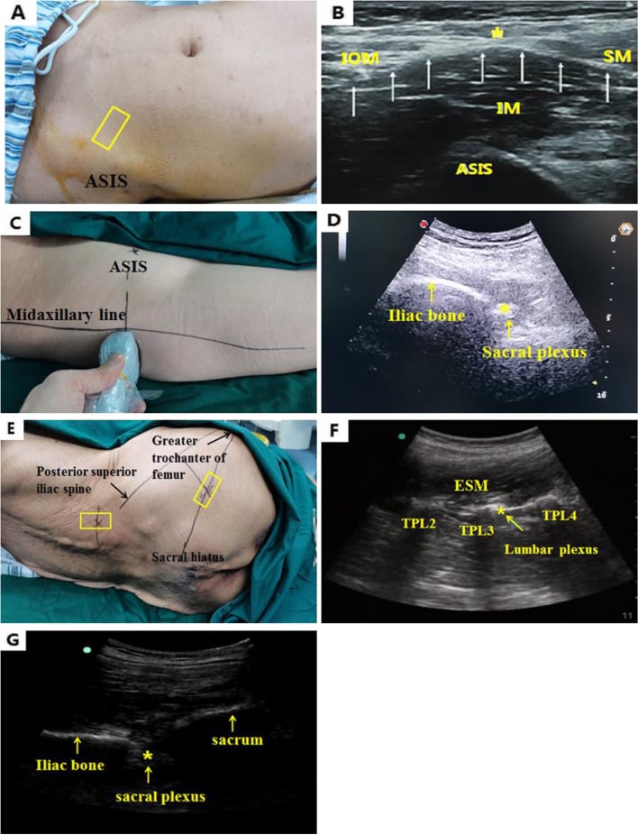 Probe position and ultrasound image for a fascia iliaca block