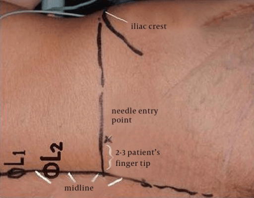 Modified entry points marked for the posterior approach to the lumbar plexus block