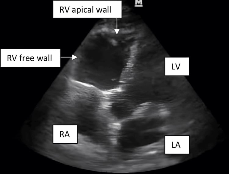 Transthoracic echocardiogram showing a hypokinetic dilated right ventricle in bone cement implantation syndrome