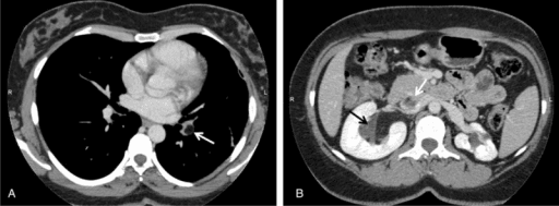Axial CT showing a fat-density filling defect in a pulmonary artery branch