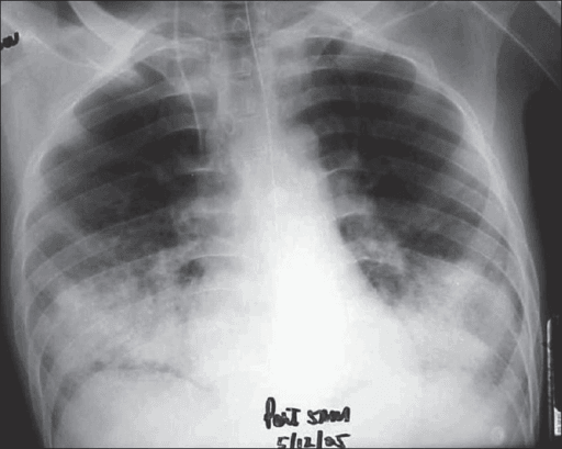 Chest radiograph showing bilateral basal air-space consolidation