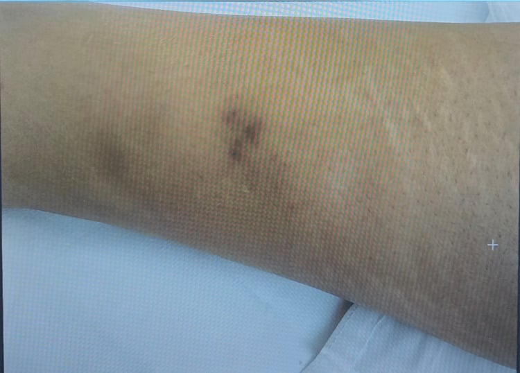 Petechial rash on the lower limb in fat embolism syndrome