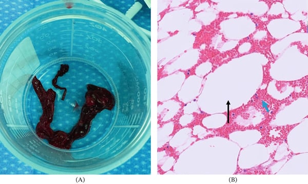 Gross and histological appearance of aspirated material showing fat in the lung