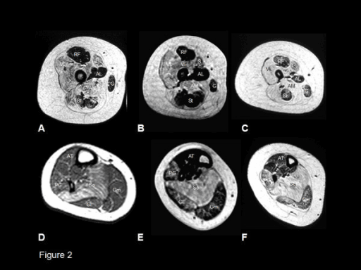 T1-weighted MRI of the proximal thigh showing muscle involvement in RYR1-related myopathy