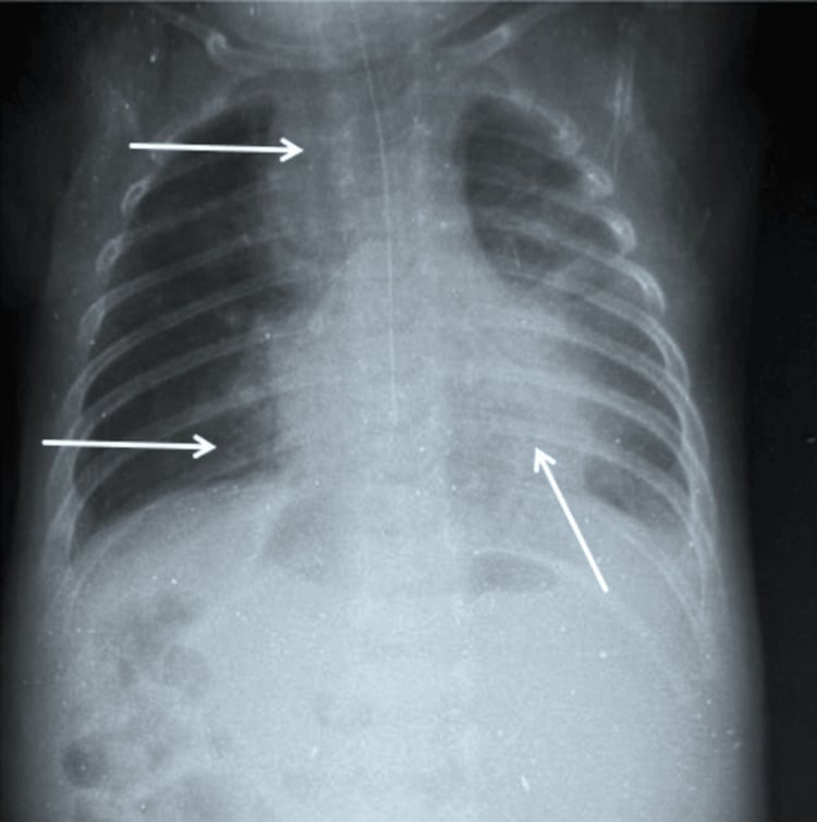Chest radiograph showing progression to pulmonary opacities at day seven