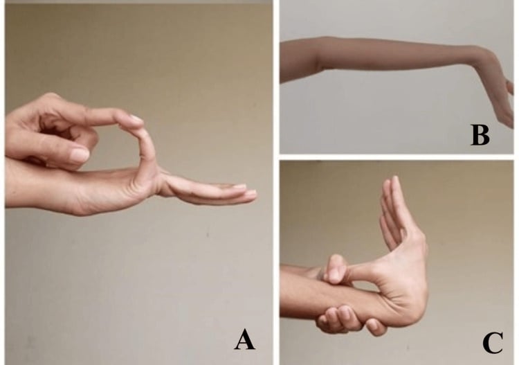 Hands and elbow demonstrating fifth metacarpophalangeal hyperextension, elbow hyperextension and thumb-to-forearm apposition.