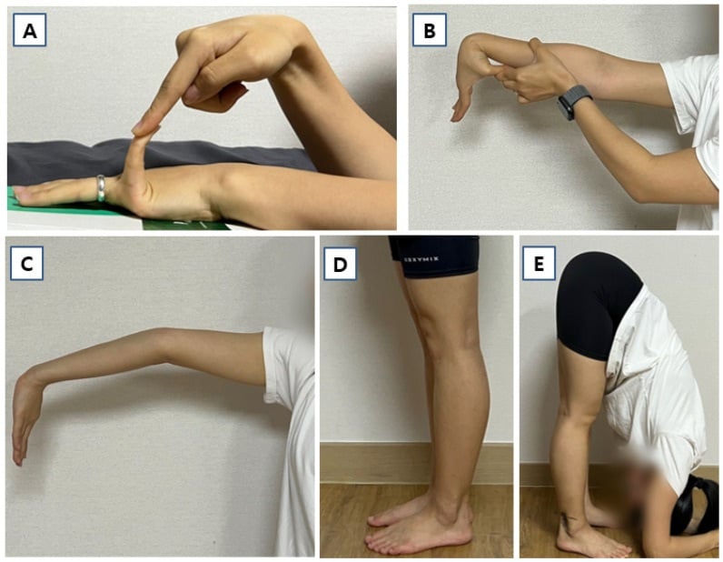 Clinical panels showing goniometric measurement of finger, elbow and knee hyperextension and forward flexion.