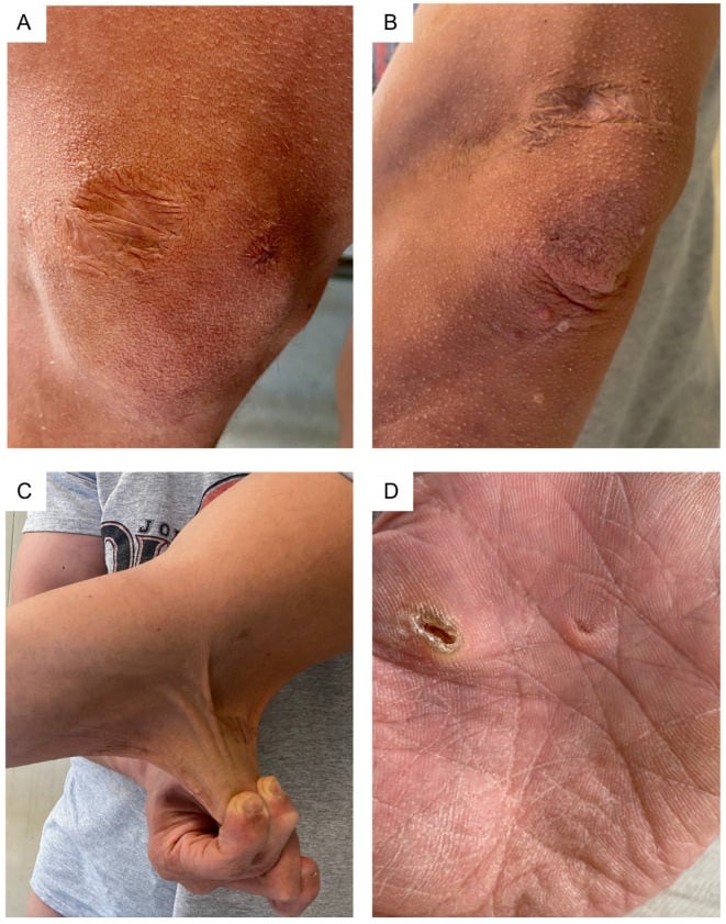 Close clinical views of atrophic scars over the knee and elbow with skin wrinkling and molluscoid pseudotumours.