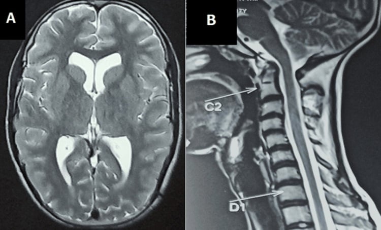 Brain and cervical-spine MRI showing atlantoaxial subluxation and cord-risk anatomy.