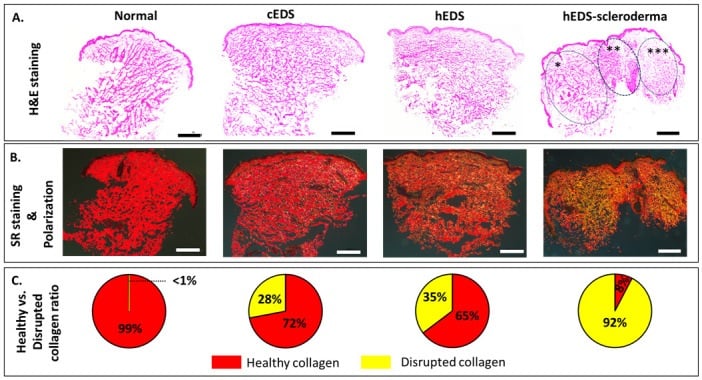 Comparative histology and polarised staining of normal, classical EDS and hypermobile EDS skin collagen.