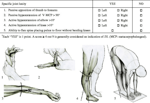 Table listing the Beighton score criteria for assessing joint laxity and their point values.