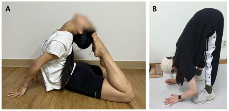 Clothed adult with a blurred face demonstrating marked spinal hyperextension and forward flexion.