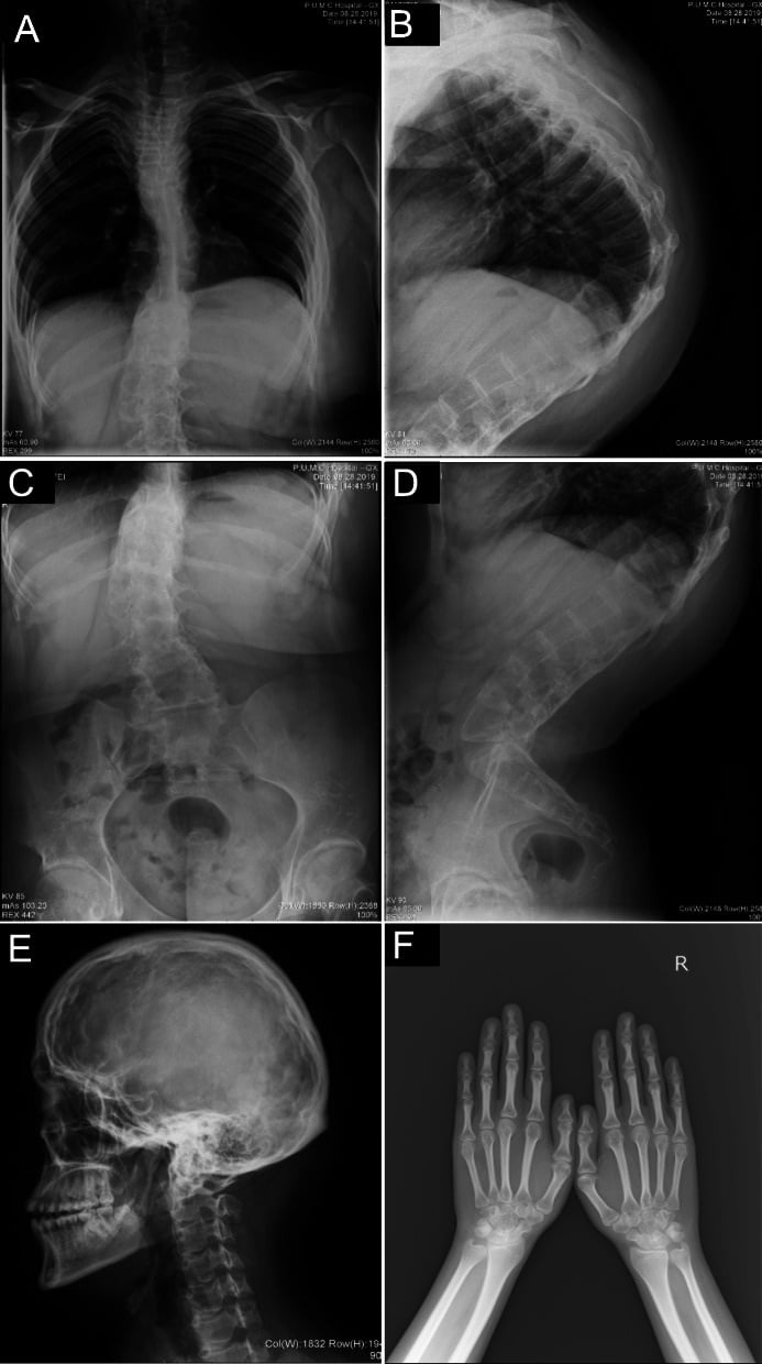 Spine, hand and lower-limb radiographs from a patient with kyphoscoliotic Ehlers-Danlos syndrome.