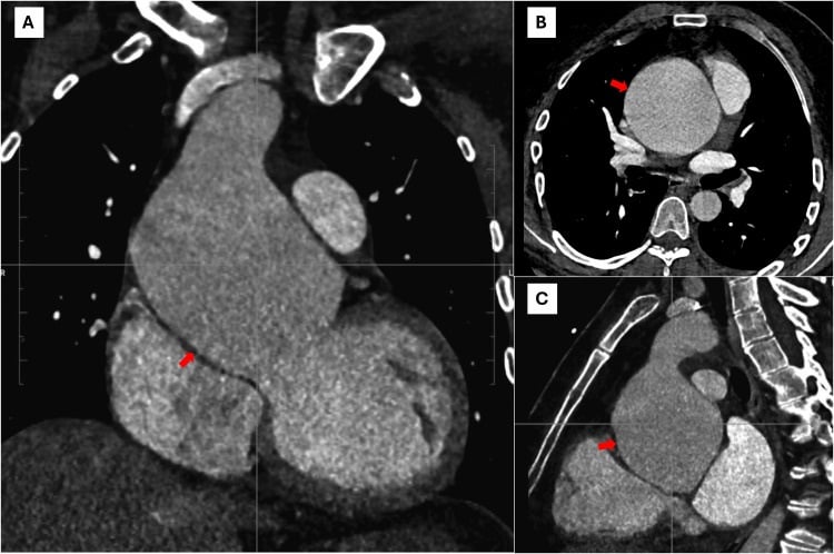 CT angiography showing marked dilatation of the aortic root and ascending aorta in a marfanoid patient.