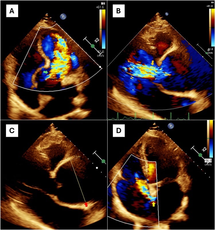 Echocardiographic views showing aortic insufficiency and a dilated aortic root.